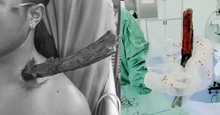 西安男行路遭跌落樹枝穿頸奇蹟生還！醫揭：再偏1mm就刺爆無名靜脈