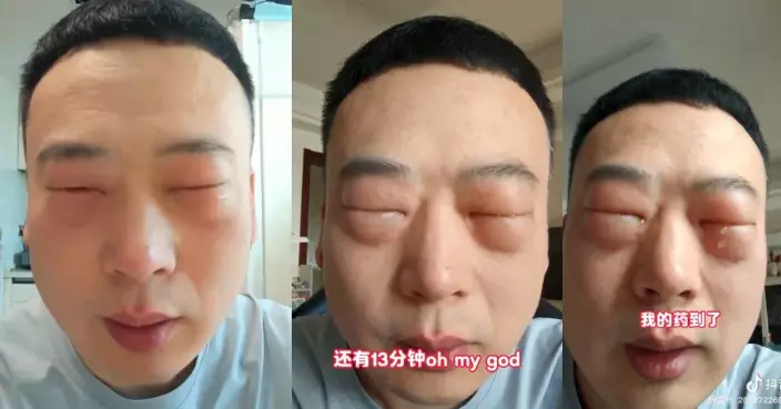 浙博主食蠶蛹過敏雙眼紅腫似「鹹蛋超人」醫生警告：嚴重恐危及性命！