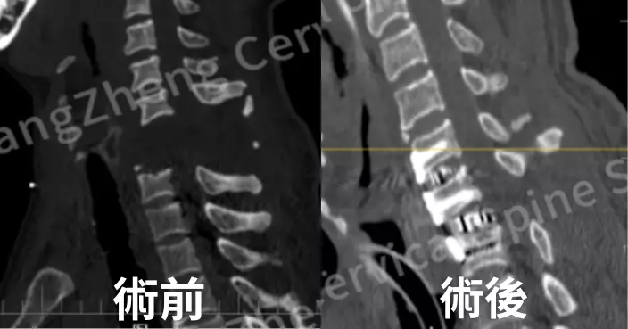 上海男頸部遭機械臂重擊 頸椎脫位近「身首分離」獲醫療團隊用創新技術救命