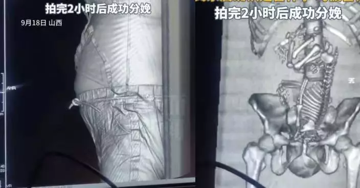 堅稱2周前來月經未懷孕 浙江19歲女腹痛就醫2小時後誕足月女嬰