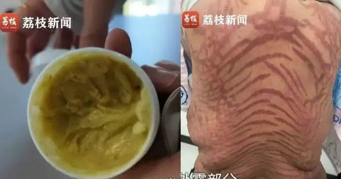 誤信「純中藥神膏」塗抹10年 內地女全身佈滿紫紅蛇紋 醫生揭含強效激素