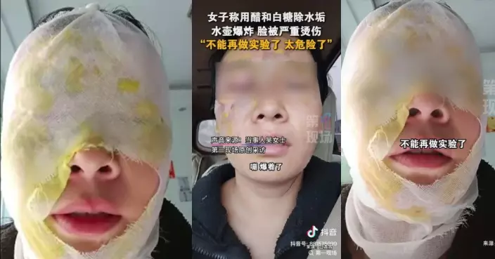 照網傳「白醋混糖除垢法」清洗保溫杯釀爆炸 河北女遭沸水噴臉重度燙傷