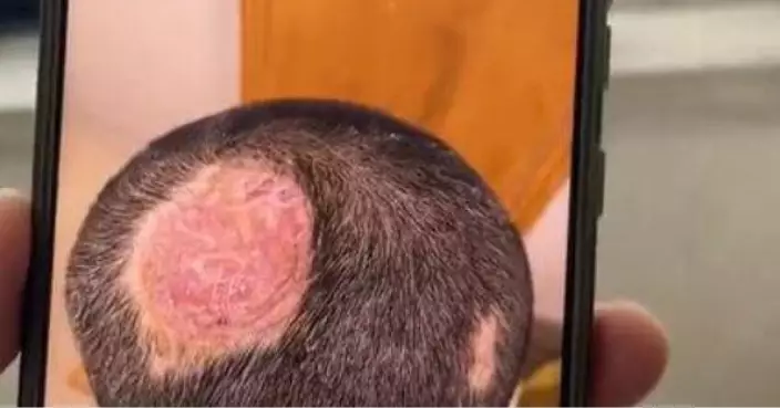 河南​​6歲男童長斑禿！養一寵物出事 真菌致膿癬留永久疤痕