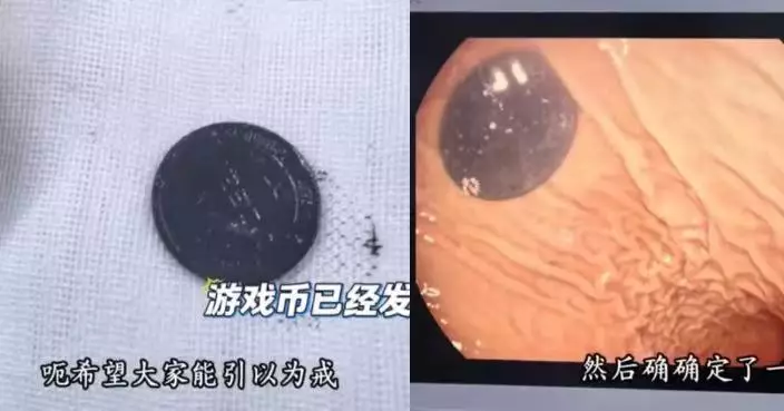 西安男童誤吞遊戲幣滯留胃內3日未排出 醫生施手術取出已「發黑發臭」