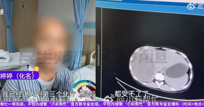 鄭州15歲少女患末期肝癌 腫瘤幾乎佔據一半肝臟 醫生疑不良飲食習慣導致