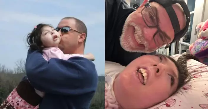 患罕見「積水性無腦症」被斷言活不過5歲 美國女奇蹟撐過20年與家人慶生