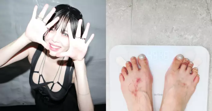 泫雅一個月勁減10公斤公開最新體重 腳背滿布傷痕親自解釋原因