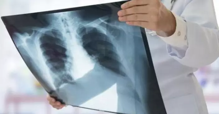 本港2023年新增癌症近38000宗 肺癌屬常見癌症第一位