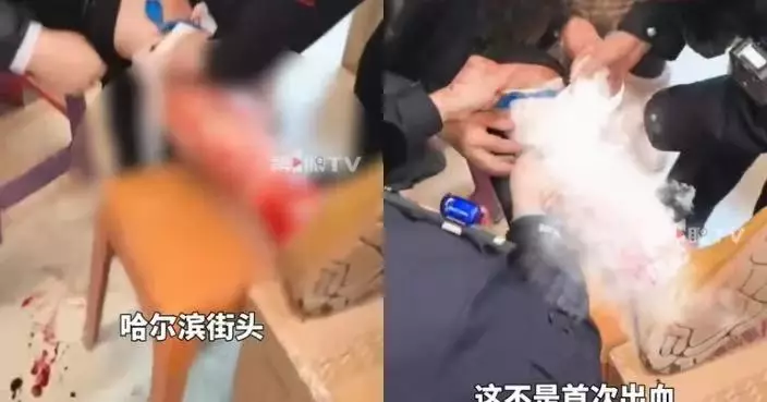 零下20度哈爾濱街頭步行疑保暖不足 南方男遊客腿部靜脈曲張凍到血管爆裂