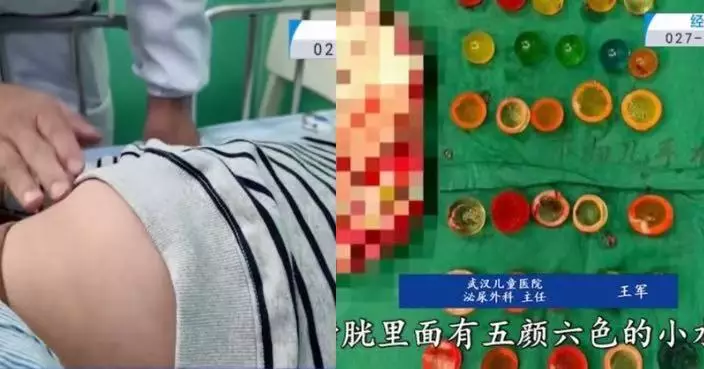 好奇塞38粒吸水珠入尿道 武漢14歲男童腹部劇痛急就醫做手術保命
