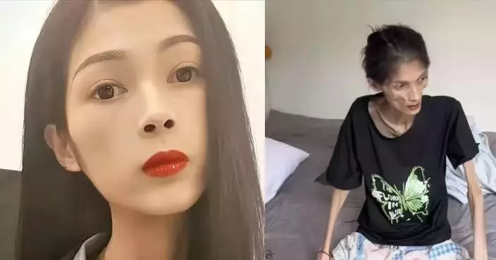 長期抑鬱併發胃萎縮 廣東女子營養吸收失效病逝 生前體重僅剩17公斤