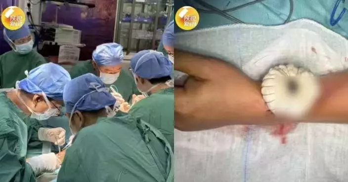 臉頰腫痛自認口腔潰瘍忍5個月始就醫 深圳男遭揭患癌獲醫取手臂皮膚縫入口修復