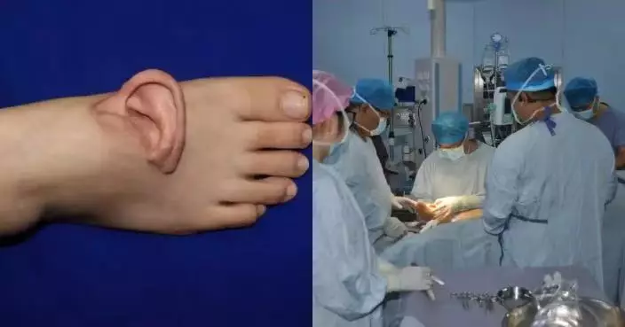 山東女左耳遭機器扯斷難即時接返 斷耳異位寄養腳背逾5個月成功「復位」