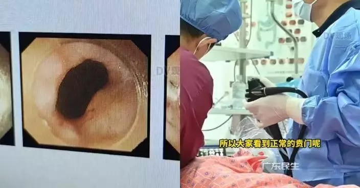 患罕見「賁門失弛緩症」飲水也困難 廣東女獲醫生30分鐘手術重拾進食能力