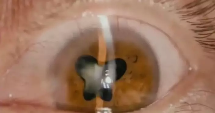 福建婦右眼劇痛畏光瞳孔現「蝴蝶狀花紋」 醫生：處理不當恐失明