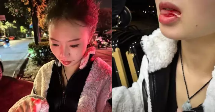 食魚遭尖銳魚刺直插舌頭 四川女爆血疼痛難耐急救醫拔除