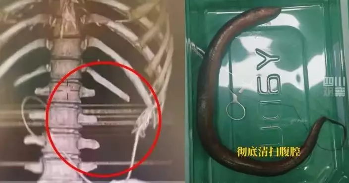 湖南漢腹痛就醫 遭揭30CM鱔魚自肛門鑽入體內腸穿孔險喪命 幸手術後脫險