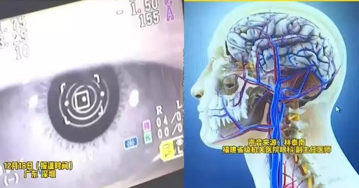 每日放學飲1罐可樂 內地女童近視年增150度 醫生：含糖飲料或影響視力發育