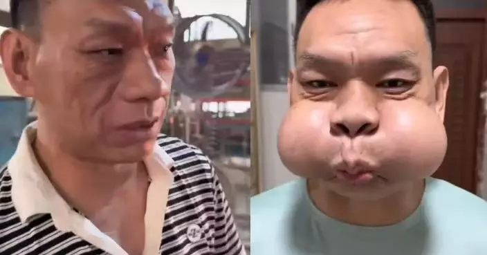 吹玻璃逾30年雙頰變形 廣東工匠臉部肌肉肥大鼓氣即變「青蛙王子」