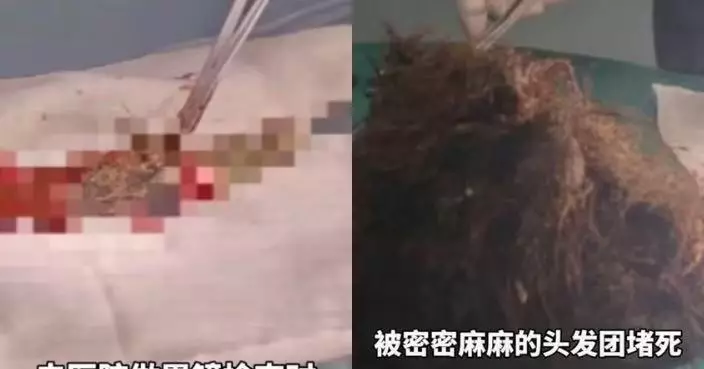 自幼兒園開始食頭髮 浙江女腹脹求醫獲醫生施手術1小時取出2斤頭髮