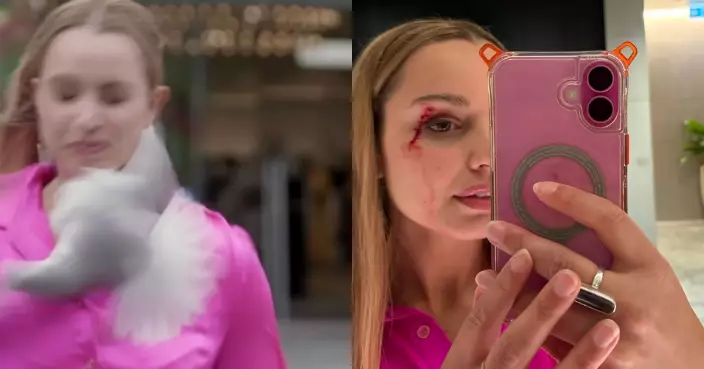 街頭直播遭失控海鷗直襲臉部 新西蘭女記者眼角爆血留傷痕