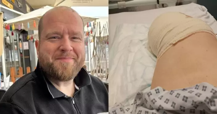 腳趾水泡久久未癒 英男就醫不足24小時感染惡化被迫截肢