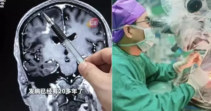 廣東男疑患癲癇21年保守治療不敢出門 就醫終揭顱內藏10cm寄生蟲手術取出