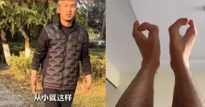 外公外婆近親結婚 安徽男天生肢體畸形長「牛蹄腳」及「螃蟹手」