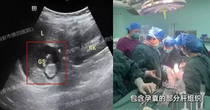西安40歲女停經就醫揭胎兒寄生肝臟 罕見宮外孕風險較宮內高90倍！