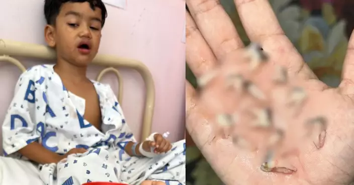 大馬4歲男童反覆頭痛嘔吐 求醫遭揭12顆乳牙全蛀須一次拔除 疑因1壞習慣所致