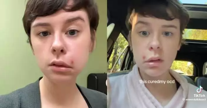 誤擠「死亡三角區」痘痘 美國女感染蜂窩性組織炎 半邊臉下垂癱瘓需住院