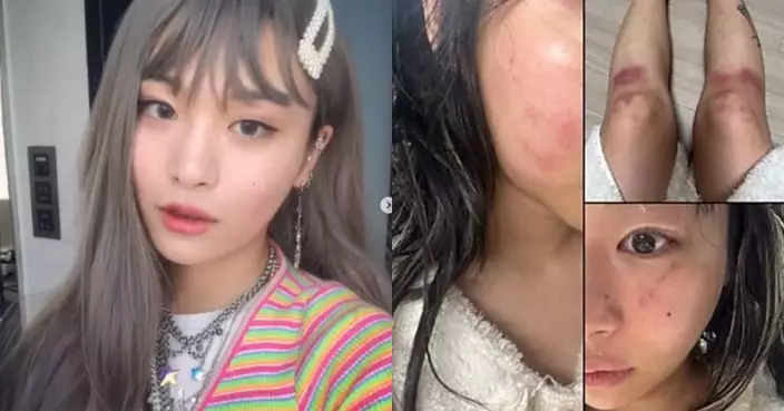 韓饒舌女歌手公開受傷圖片 指控前男友施暴甚至掐脖子