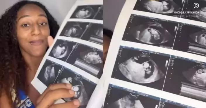 全球不足10例！巴西女孕期再受孕 同晚誕下差一周「異期孖胎」