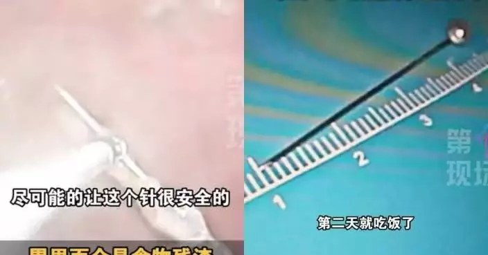 廣東男童自製吹箭玩具誤吞3.5CM大頭針入胃腔 醫生緊急手術取出