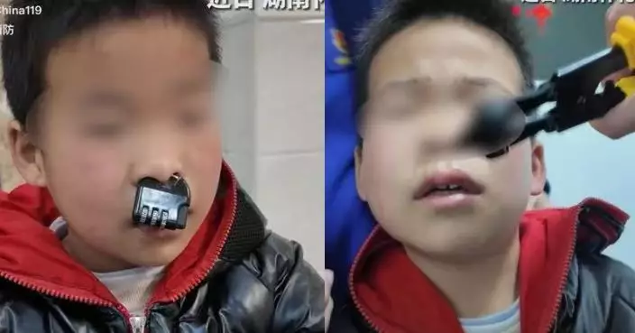 密碼鎖套鼻孔卡住 湖南奀皮男童驚變「牛魔王」 幸獲消防剪開解救