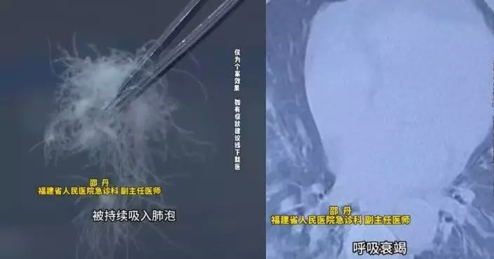 連續4周著破損羽絨服日逾12小時 福建男呼吸困難求醫確診「羽絨肺」