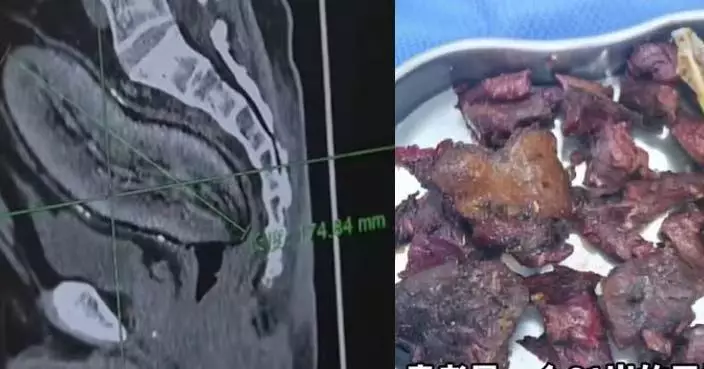 將17CM長番薯塞入肛門 成都翁劇痛難忍就醫 需接受開腹手術取出