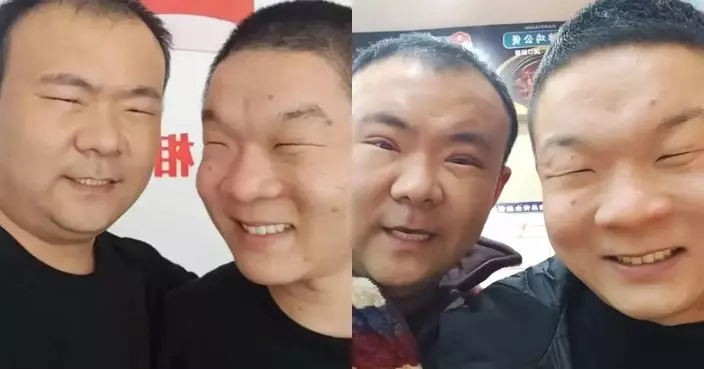河南兄弟遺傳爸爸「瞇瞇眼」被嘲睜眼閉眼無分別 哥動刀隔雙眼皮重拾自信