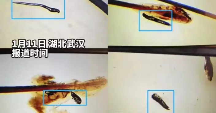 長期卸妝不徹底 湖北女眼睛奇癢求醫遭揭睫毛毛囊藏6條蠕形蟎蟲