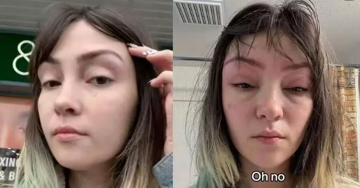 染眉翌日嚴重過敏 加女臉部腫脹睜不開眼似「外星人」 兩周後才消退