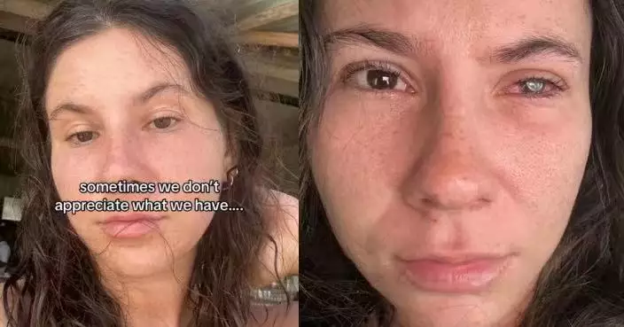 美國女右眼劇痛如刀割視力下降 就醫確診染「罕見寄生蟲」或因隱形眼鏡惹禍