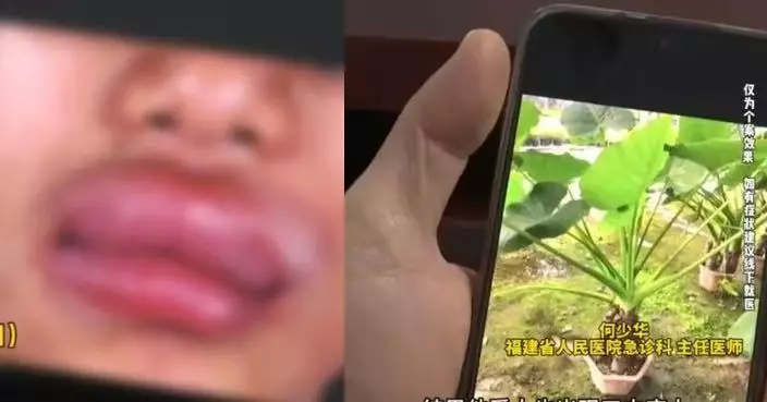 野外挖芋頭誤食姑婆芋 福建夫婦中毒口舌腫脹急求醫 醫警告：或釀更嚴重後果