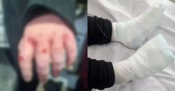 獨遊東北昏倒雪地 四川女大生重度凍傷左手3指壞死恐需截肢