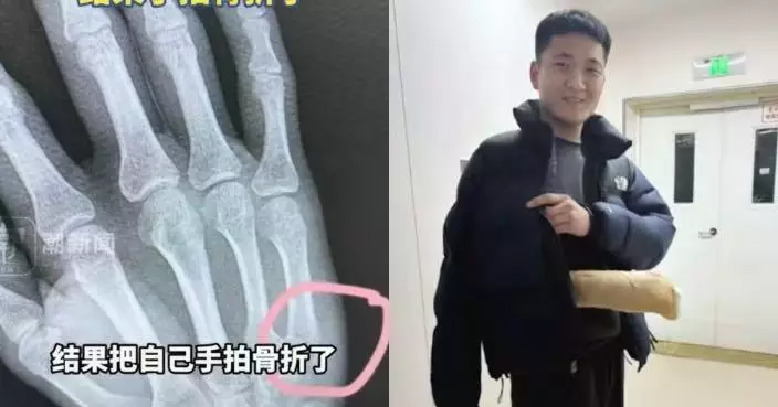 孩子做功課半小時只寫18字 山東父怒拍桌洩憤致手部骨折