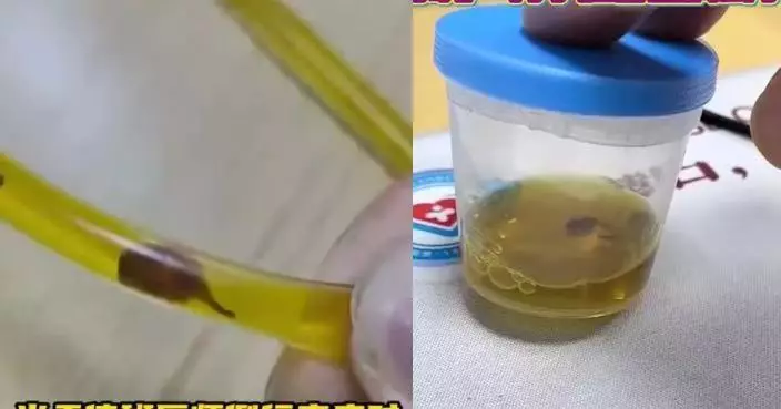 疑生食淡水生惹禍！東莞男腹痛就醫引流膽汁驚現「肝吸蟲蠕動」