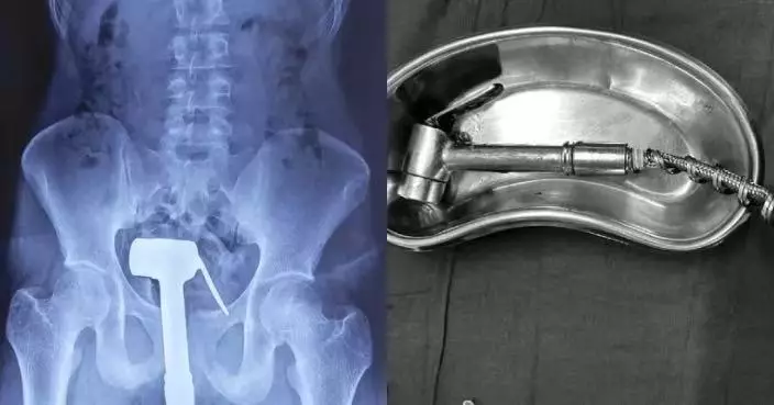 淋浴器直插肛門無法取出 印度智障男找水電工截水管後再求醫取出