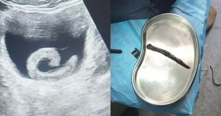 河南漢誤信偏方塞5CM活水蛭入尿道 遭鑽入膀胱吸血爆痛急求醫需手術取出