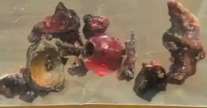 杭州女鼻塞流膿逾10年當鼻竇炎 就醫鼻腔取出「陳年串珠」已鈣化成石