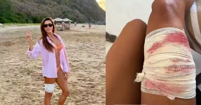 巴西女律師浮潛突遭鉸口鯊狠咬大腿不放 獲導遊出手相救死裡逃生