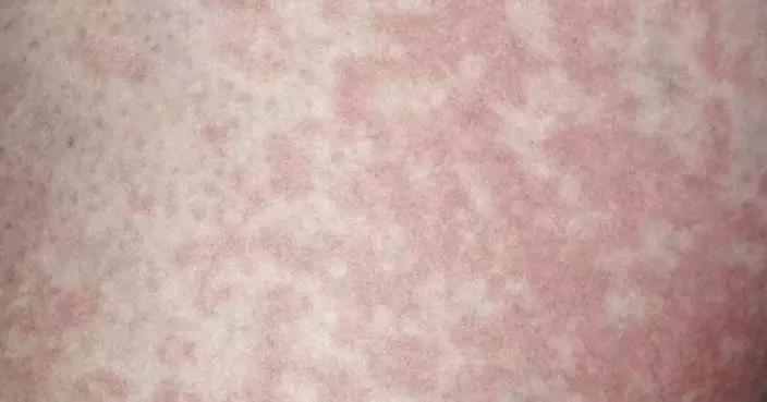 河南6旬漢大腿現紅斑就醫確診「股癬」患腳癬長期將內褲襪子混洗惹禍